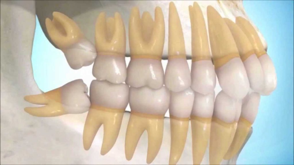 Mierda dígito Cielo CUANDO SACAR LAS MUELAS DEL JUICIO? | Dentista y ortodoncista para niños en  Carballo